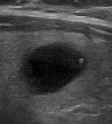 Ecografía tiroidea mostrando artefacto de cola de cometa en estructura quística