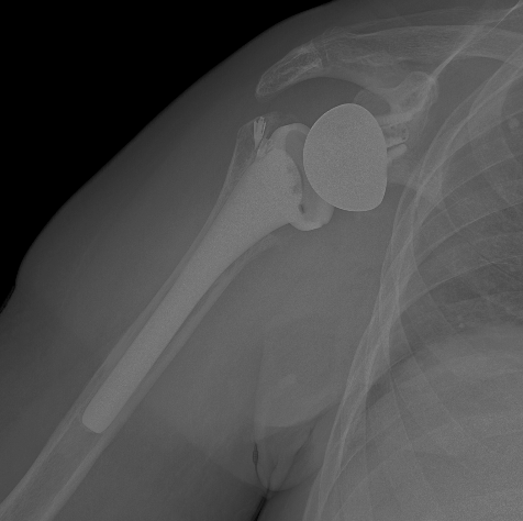 Radiografía simple mostrando prótesis de hombro