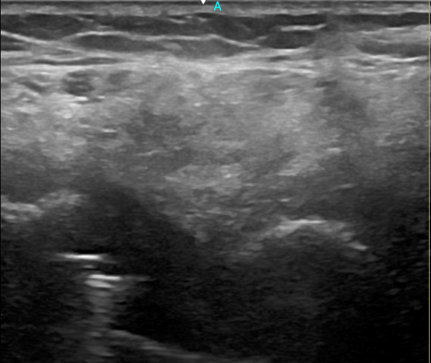 Imagen de ecografía