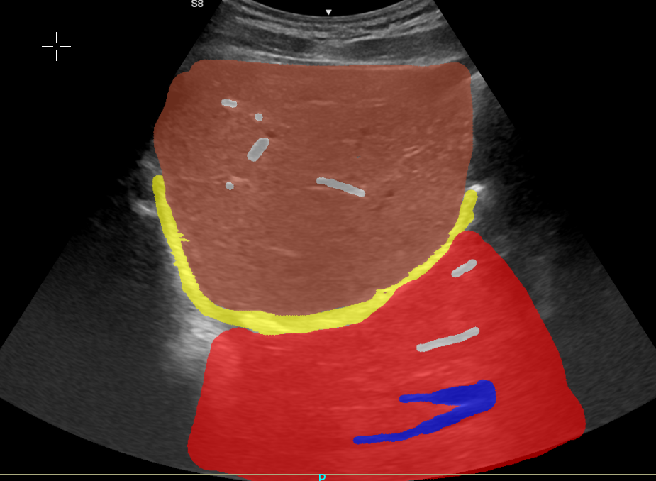 Artefacto en espejo en región hepática con etiquetas anatómicas