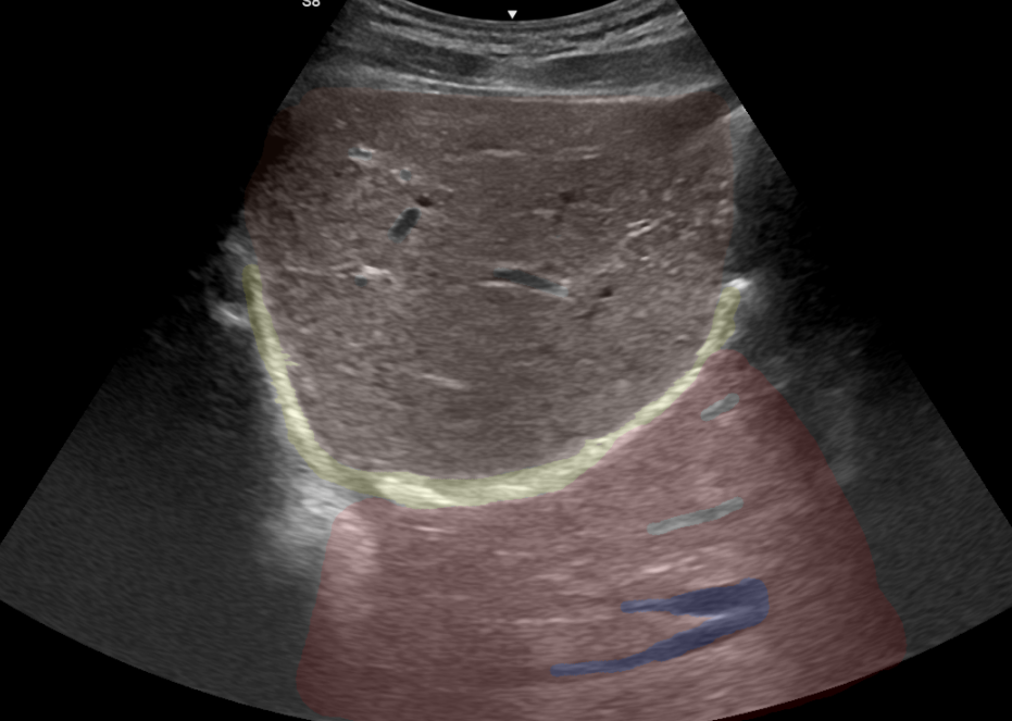 Imagen de ecografía