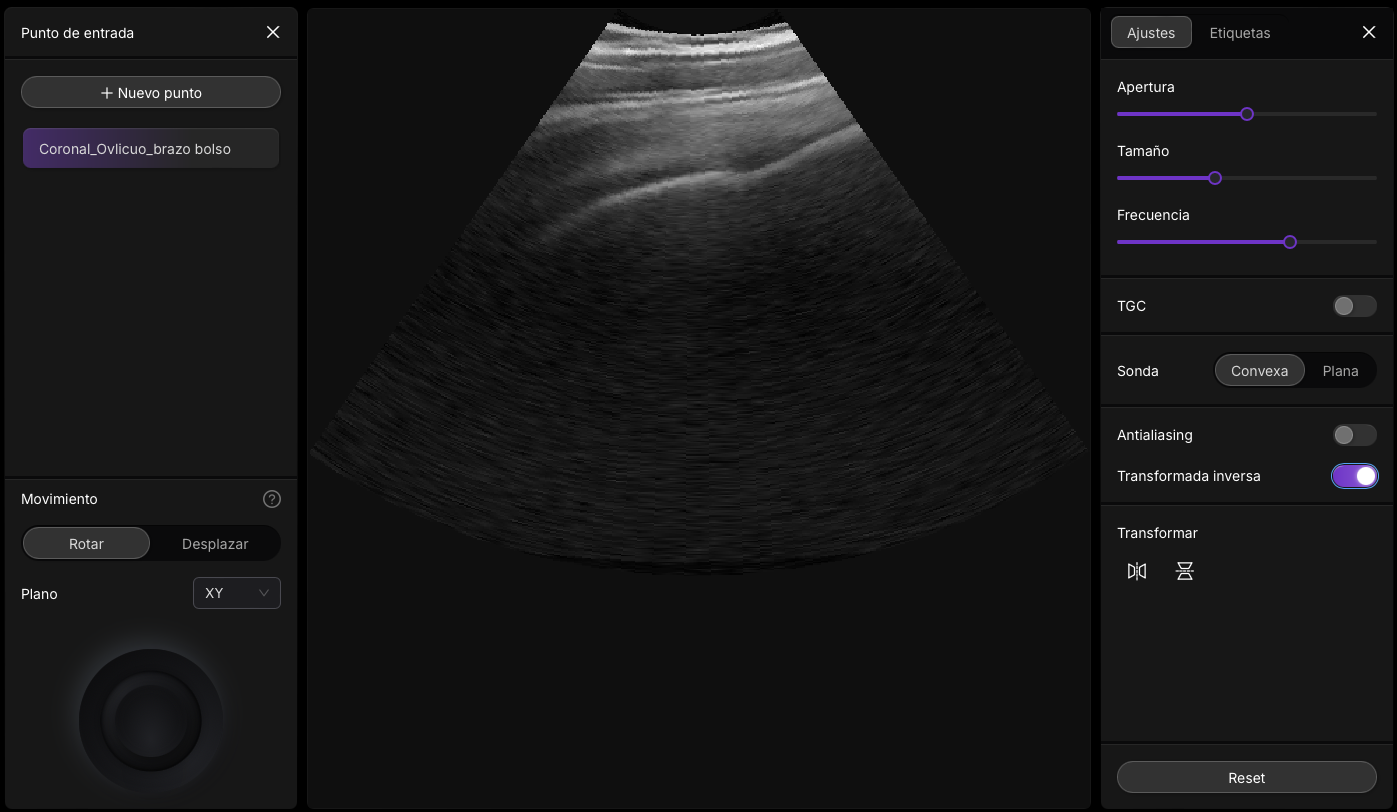 Ecografía mostrando tendón del supraespinoso en su inserción en troquiter