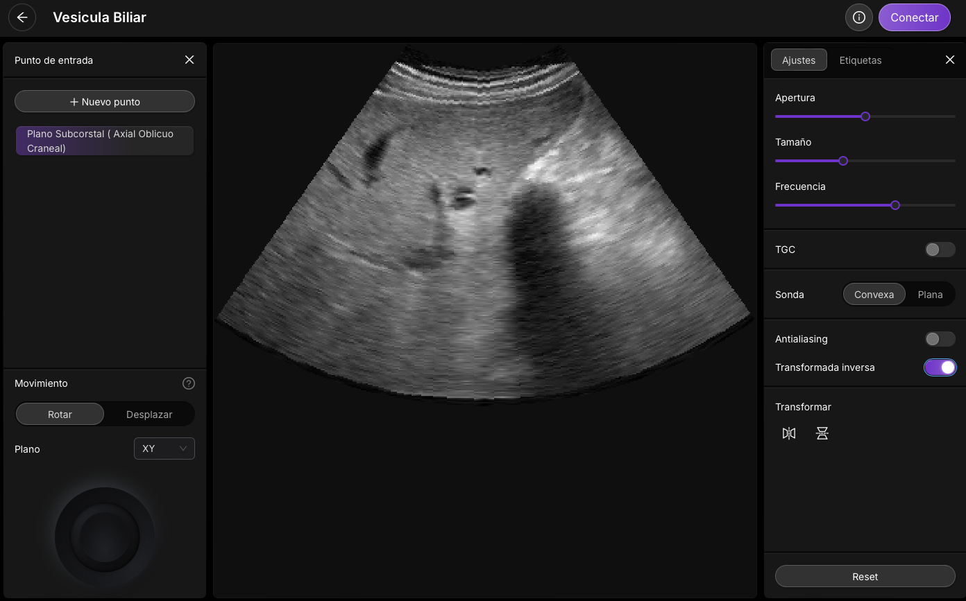 Ecografía abdominal mostrando estructura hiperecogénica con sombra acústica