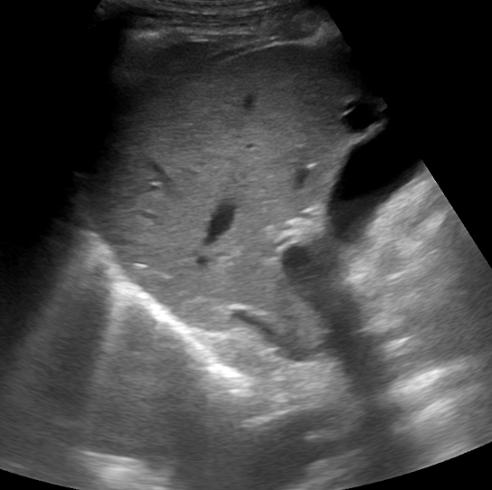 Imagen de reverberación diafragmática mostrando líneas paralelas