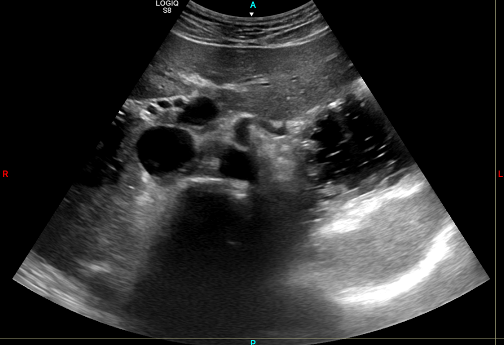 Corte axial subxifoideo mostrando sombra acústica posterior a la aorta abdominal
