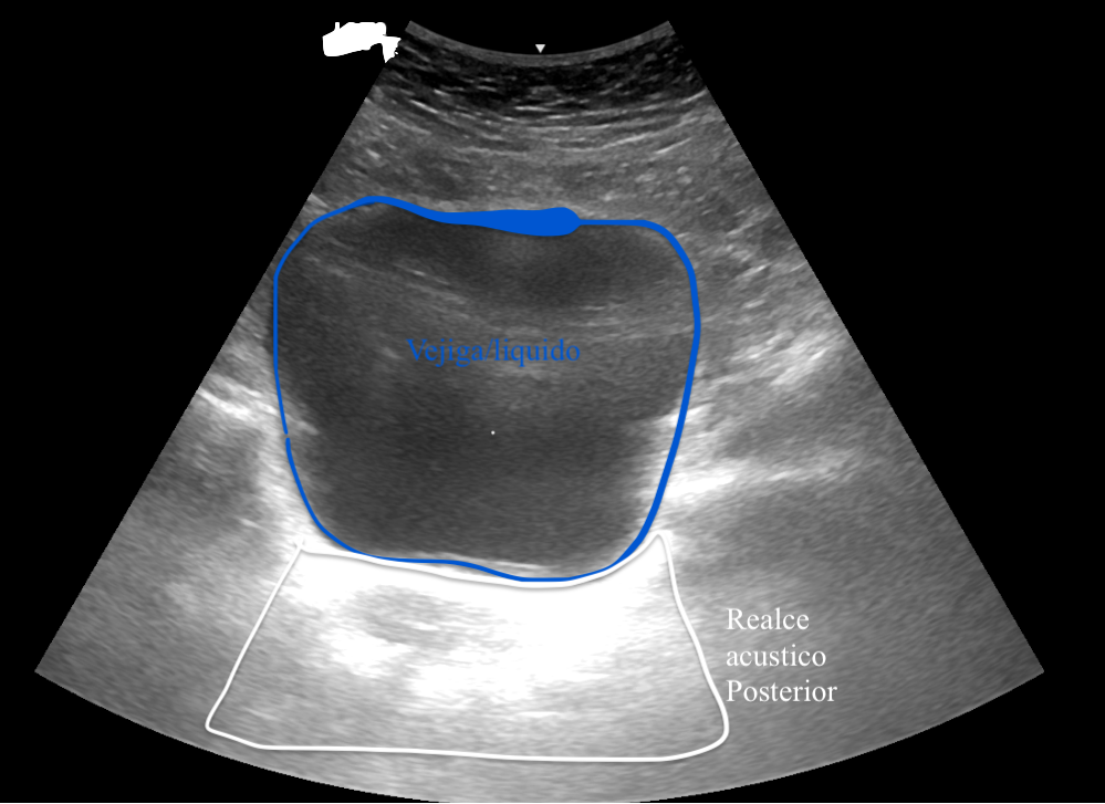 Vejiga con refuerzo acústico posterior en corte suprapúbico